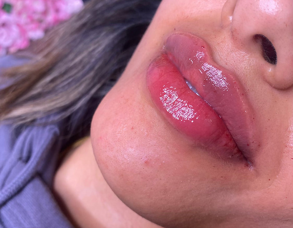 1ML LIP FILLER