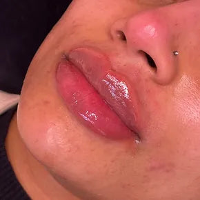 0.75ML LIP FILLER